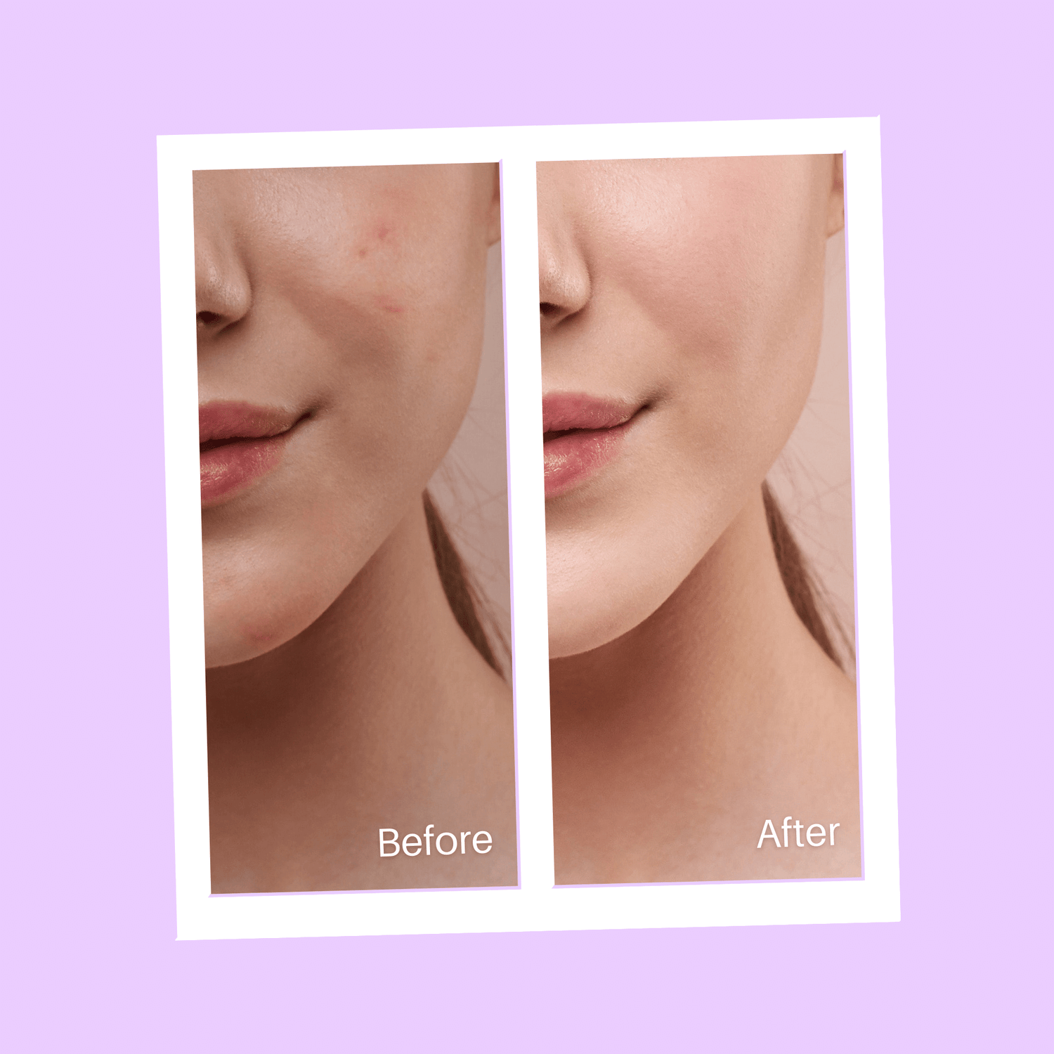 Before and after acne treatment image from Ecladerm